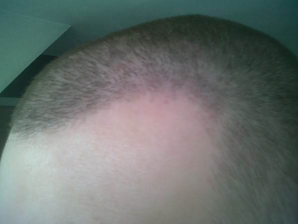 BHR Clinic FUE Hair Transplant9.jpg