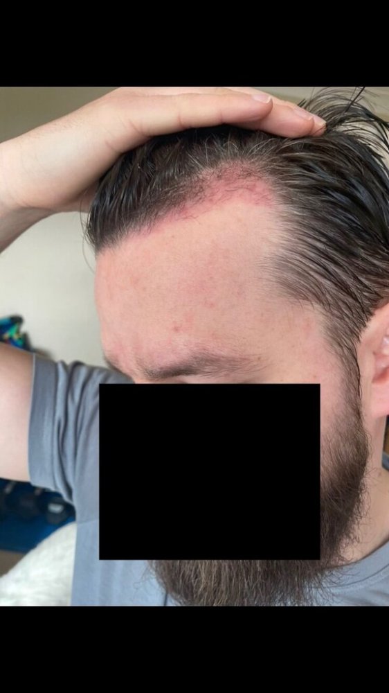 BHR Clinic FUE4.jpeg