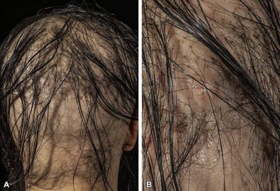 Biofibre artificial hair.jpg