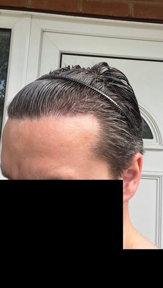 Bisanga 4 months post-op5.jpeg