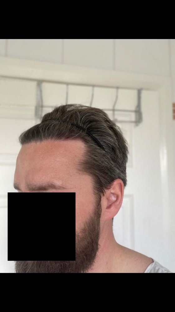 Bisanga 4 months post-op8.jpeg