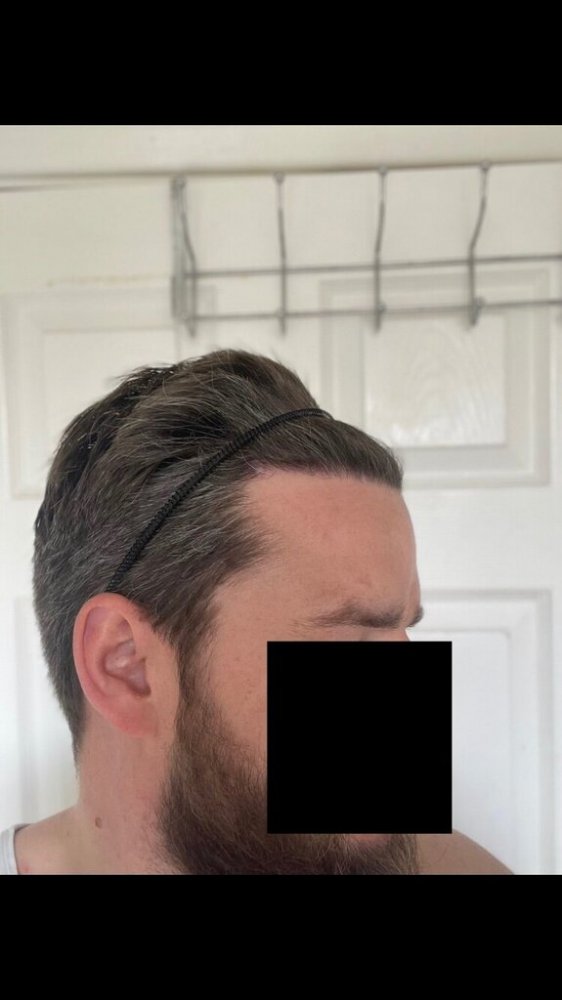 Bisanga 4 months post-op9.jpeg