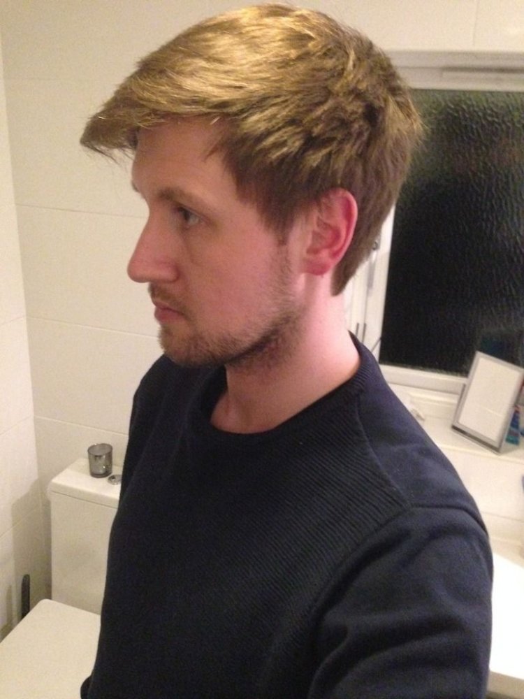 Bisanga hair transplant2.jpg