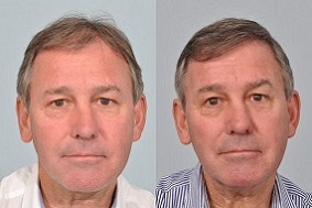 Bryan Robson hair transplant.jpg