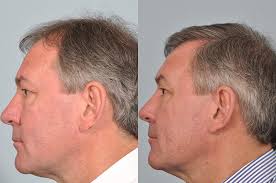 Bryan Robsons hair transplant.jpg