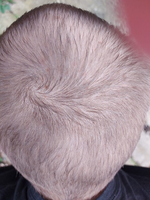 Crown 12 months with Finasteride.jpg