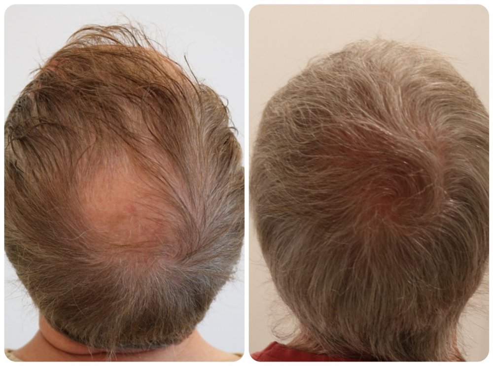 Crown 1500 grafts 30 grafts cm2 no spotlight.jpg
