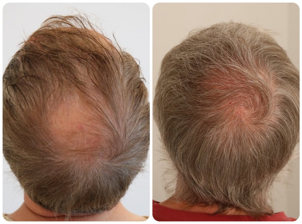 Prohairclinic 1500 Grafts Crown Area With And Without Spotlight