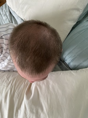 Crown FUE hair transplant.jpeg