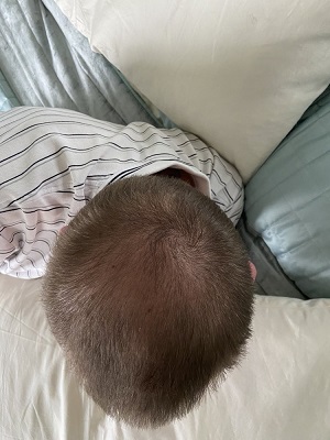 crown hair transplant.jpeg