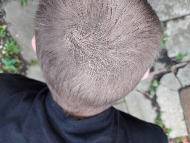 Crown resukt 12 months of Finasteride.jpg