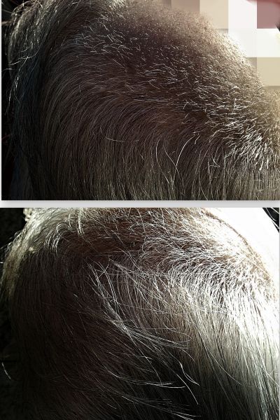 Hair-growth-promoting solution containing chlorine dioxide | Hair loss  Forum - Hair Transplant forums