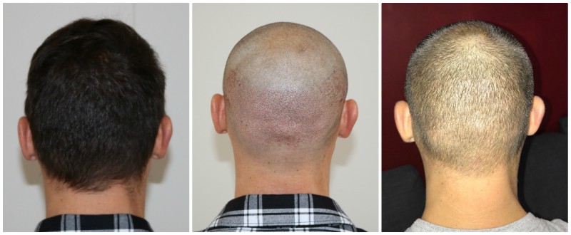 donor xavier full shave 2000 grafts.jpg