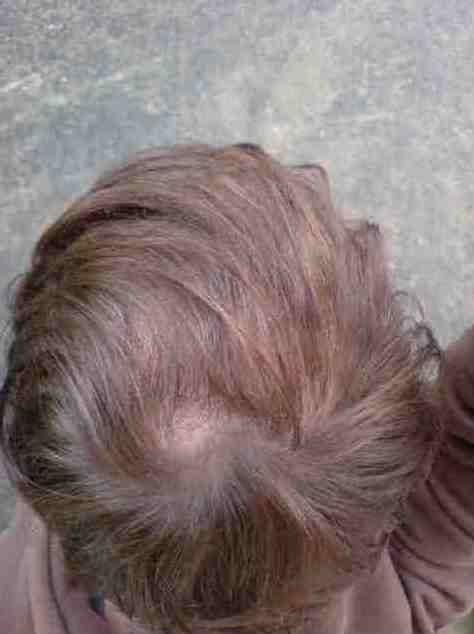 Double crown 12 month hair transplant result.jpg