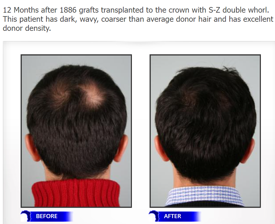 Double crown hair restoration.png