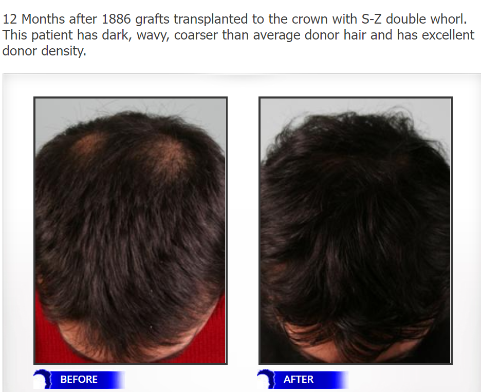 Double crown hair transplant.png