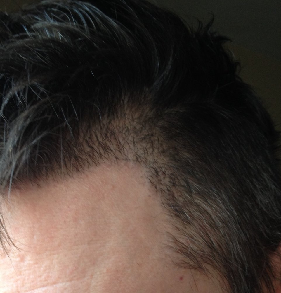 Double triples along edge hairline.JPG