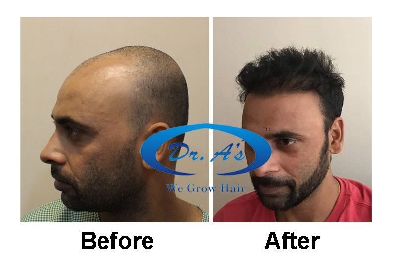 Dr Arvind Hair Transplant2.jpg
