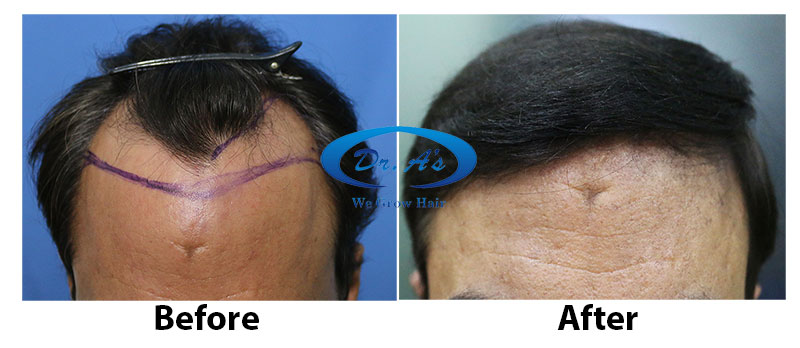 Dr Arvind Poswal hair transplant 1.jpg