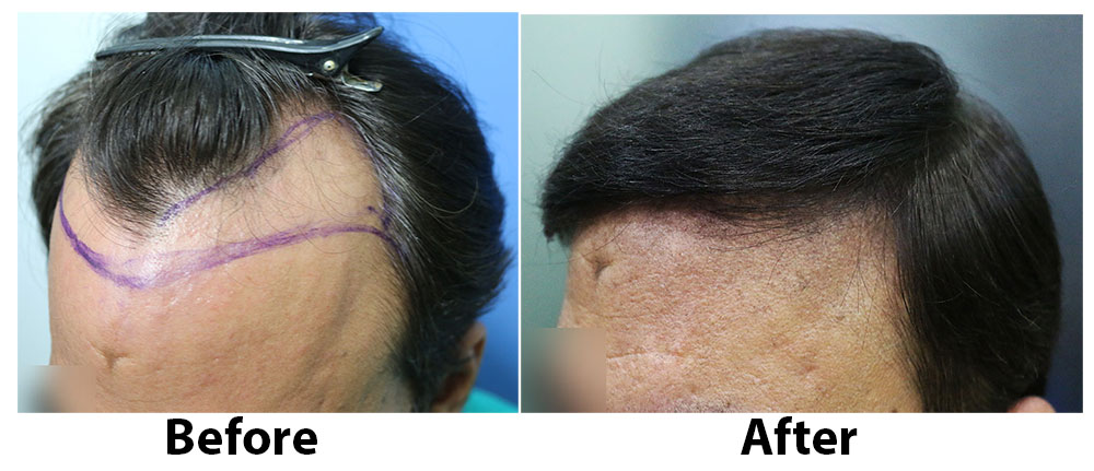 Dr Arvind Poswal hair transplant 2.jpg