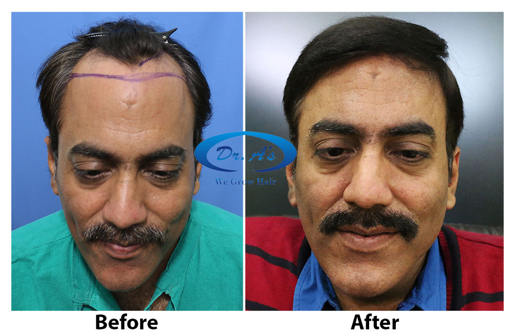Dr Arvind Poswal hair transplant.jpg