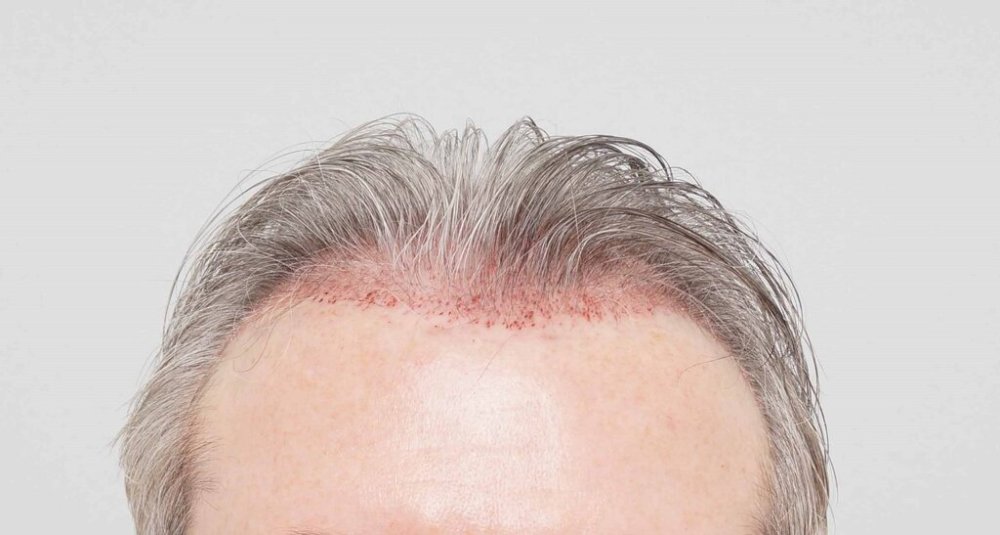 Dr. B farjo hair transplant result6.jpg