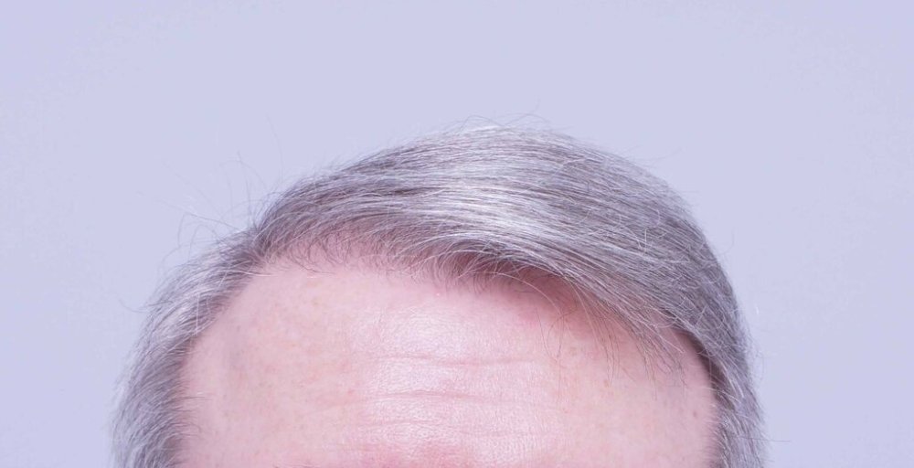 Dr. B farjo hair transplant result9.jpg