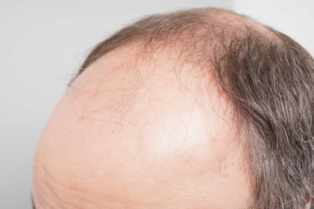 Dr. B Farjo hair transplant5.jpg