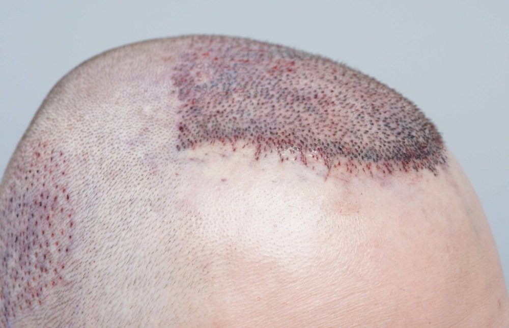 Dr B Farjo hair transplant6.jpg