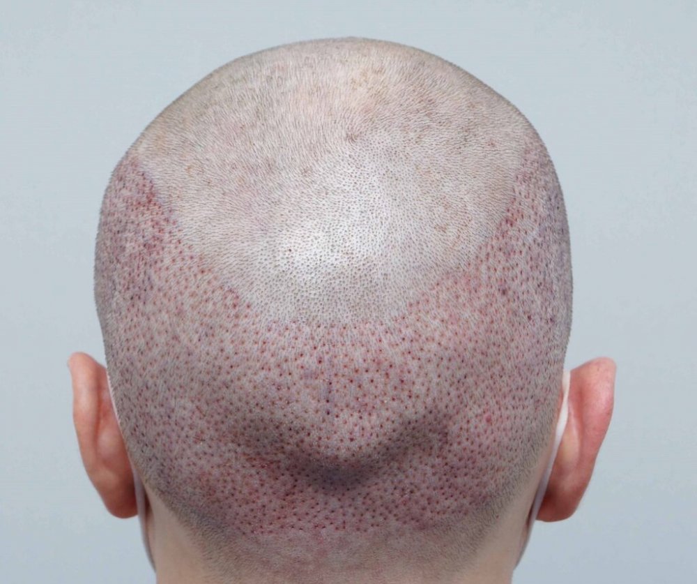Dr B Farjo hair transplant8.jpg