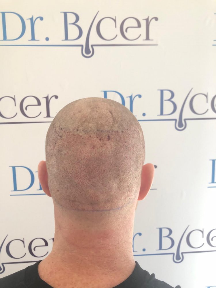 Dr Bicer FUE hair transplant.jpeg