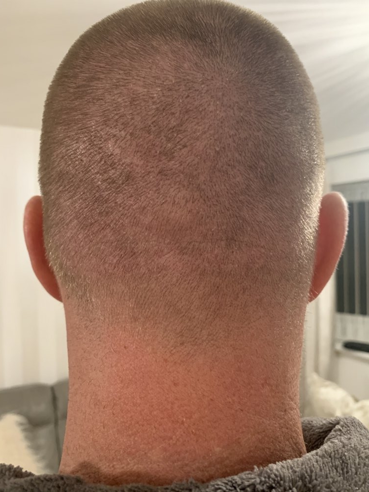 Dr Bicer hair transplant donor area.jpeg