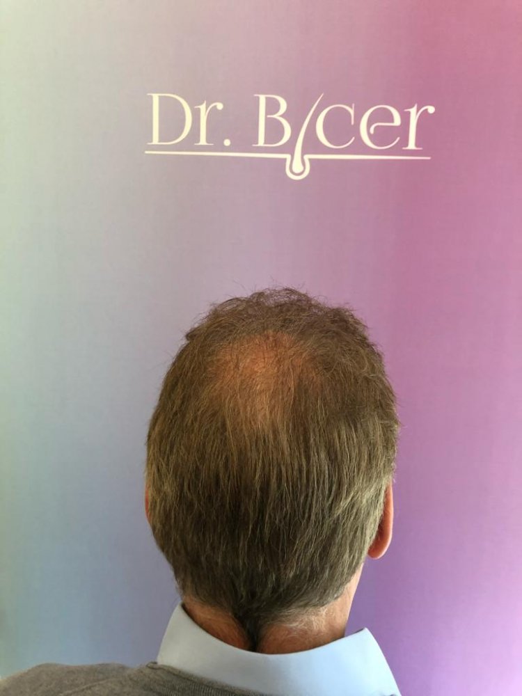 Dr Bicer hair transplant.jpeg