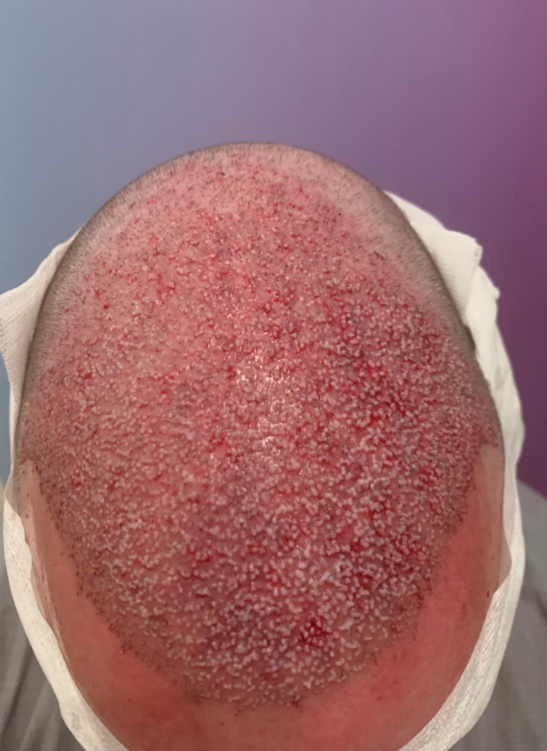 Dr Bicer hair transplant .png