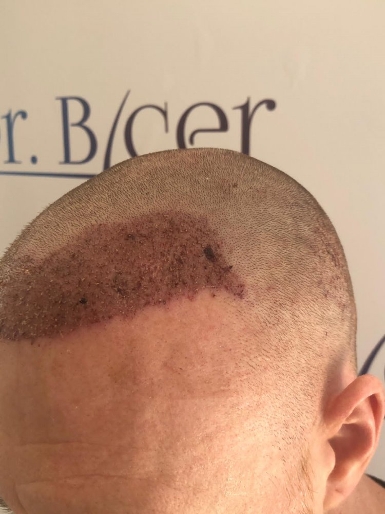 Dr Bicer hair transplant Turkey.jpeg