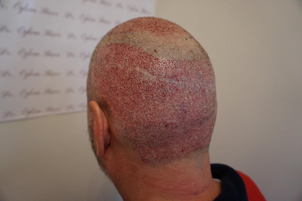 Dr Bicer Scar repair and FUE hair transplant.jpeg
