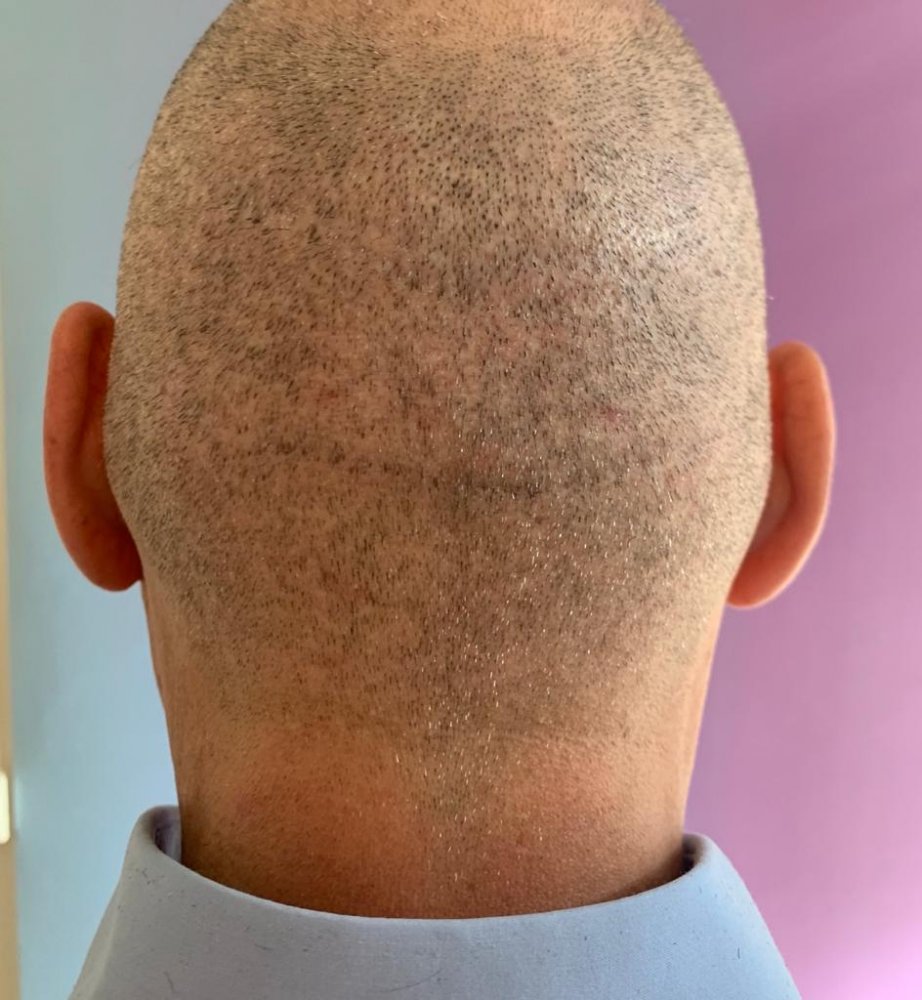 Dr Bicer Scar repair and FUE hair transplant post op.jpeg