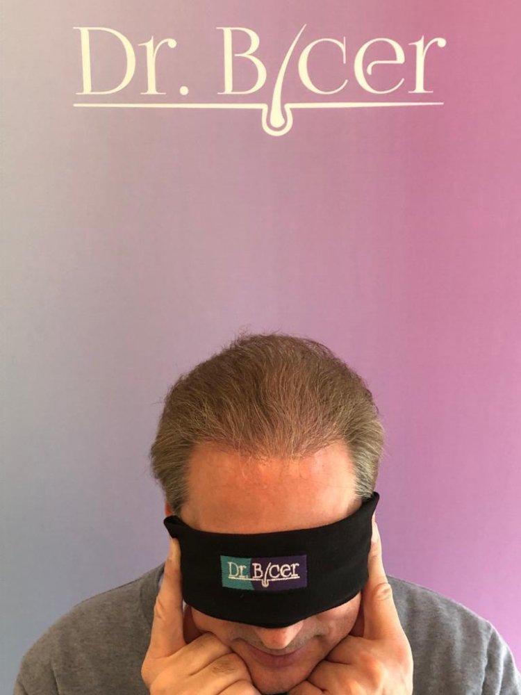 Dr Bicer Scar repair FUE hair transplant1.jpeg