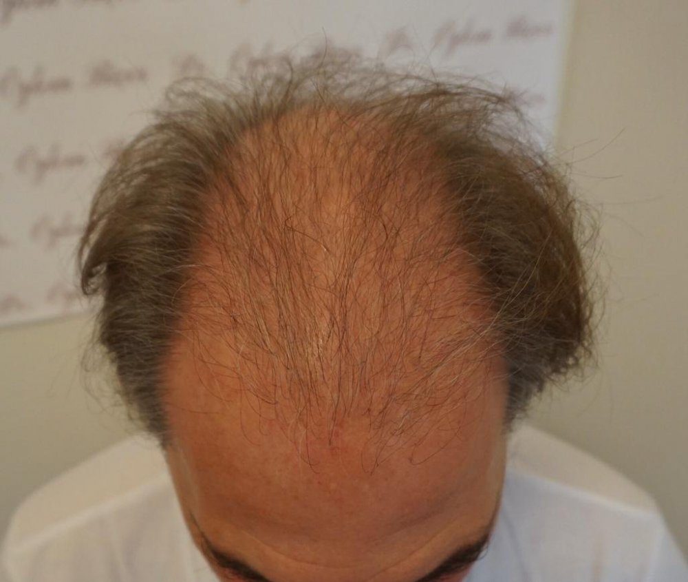 Dr Bicer Scar repair1.jpeg