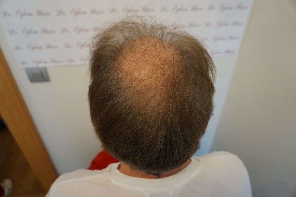 Dr Bicer Scar repair3.jpeg
