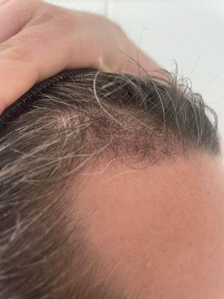 Dr Bisanga 3 month post-op6.jpeg