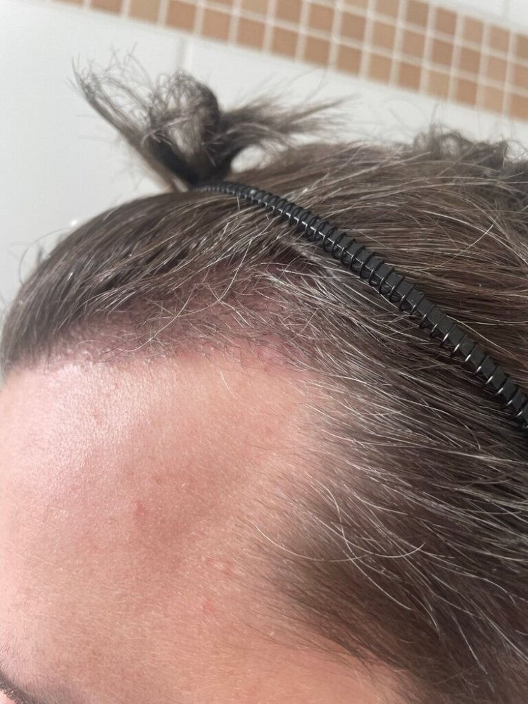 Dr Bisanga 3 month post-op7.jpeg