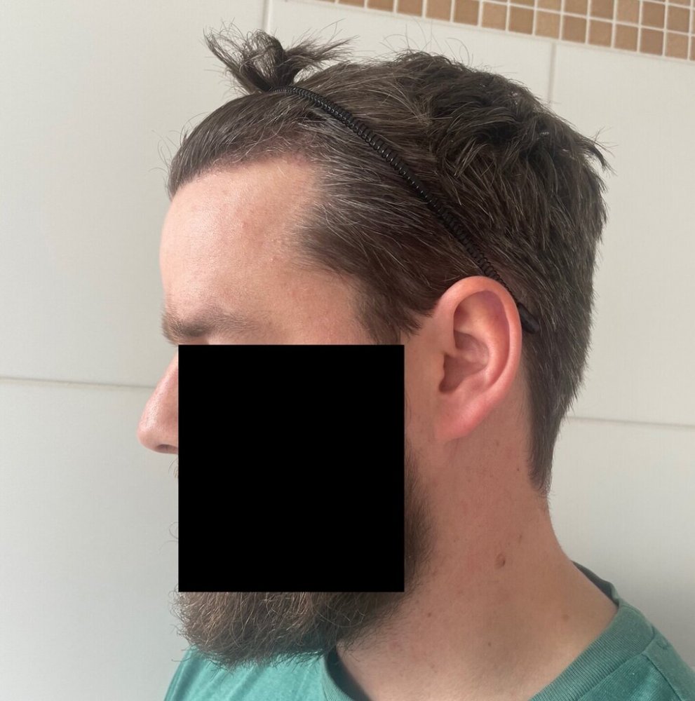 Dr Bisanga 3 month post-op8.jpeg