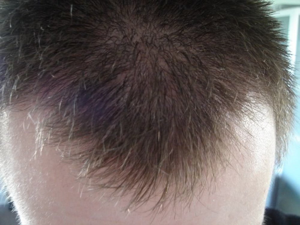 Dr. Bisanga FUE Hair Transplant patient1.jpg