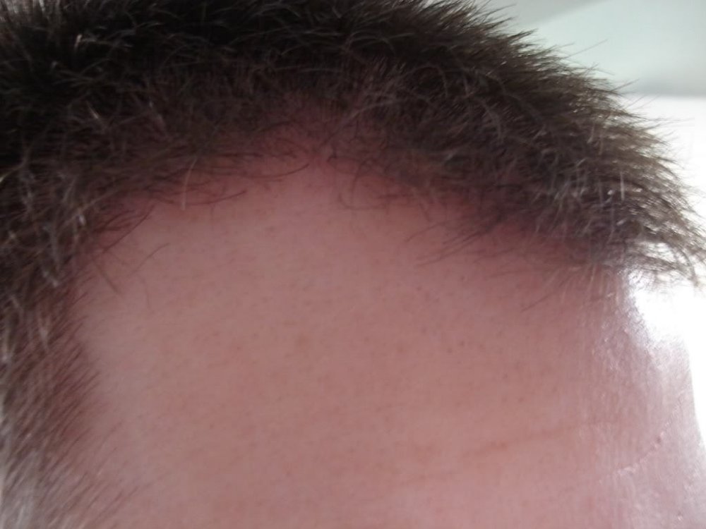 Dr. Bisanga FUE Hair Transplant patient2.jpg