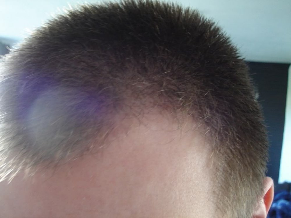 Dr. Bisanga FUE Hair Transplant patient3.jpg