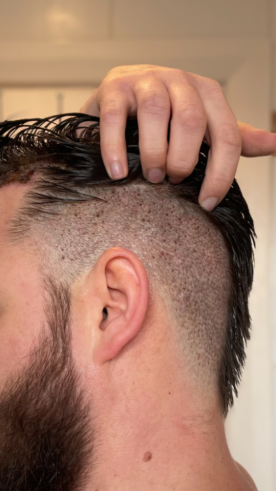 Dr Bisanga fue hair transplant1.png