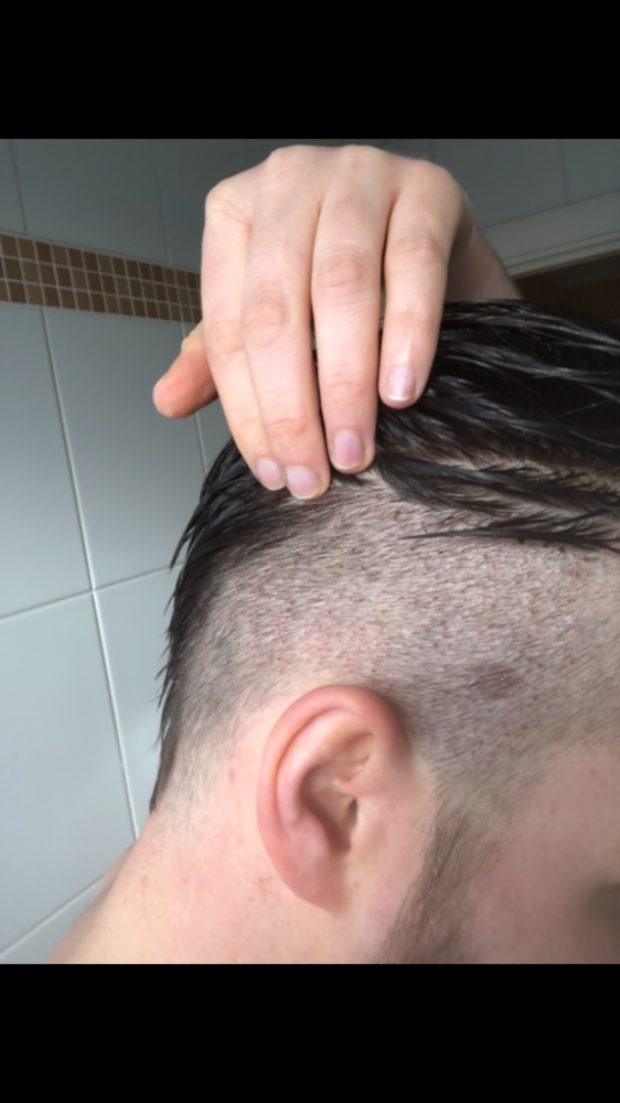 Dr Bisanga fue hair transplant10.png