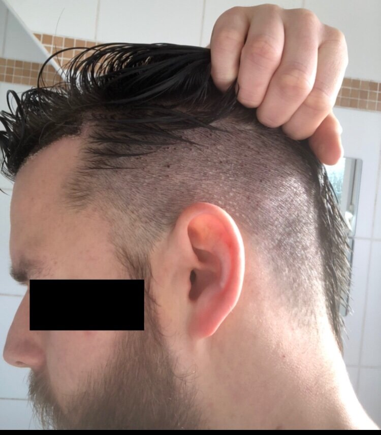 Dr Bisanga fue hair transplant11.jpeg