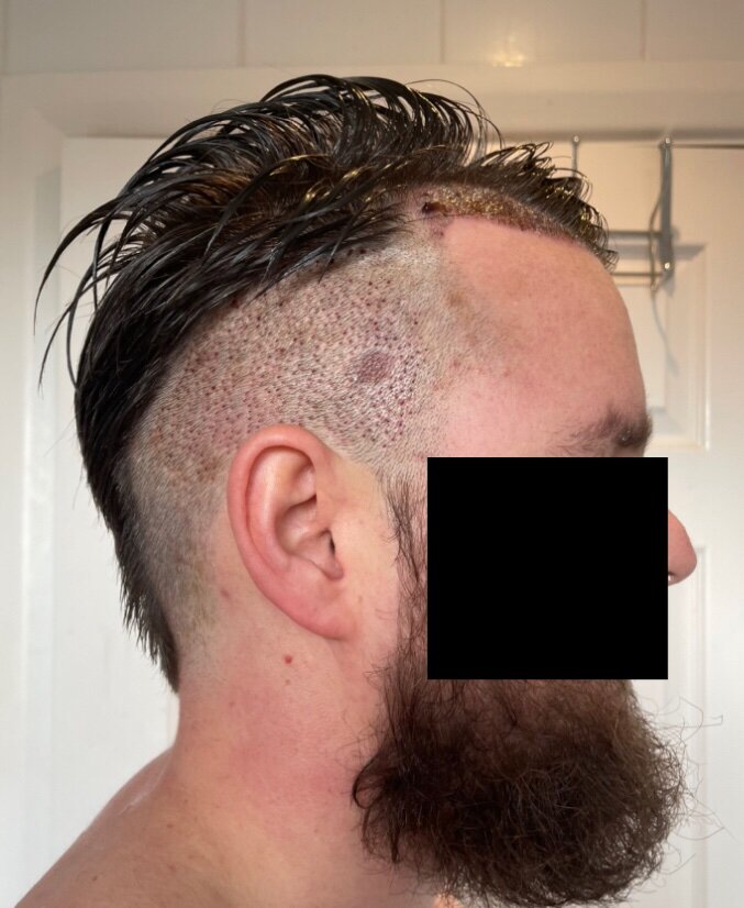 Dr Bisanga fue hair transplant2.jpeg